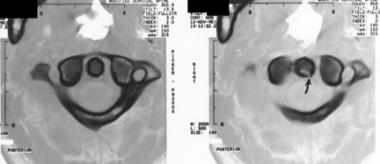 Odontoid type II fracture 