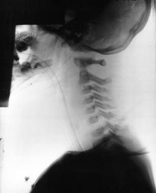 Atlantooccipital and atlantoaxial dissociation 