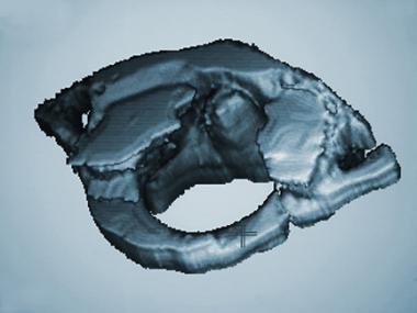 Three-dimensional CT scan of C1. 