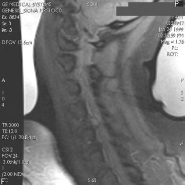 T1-weighted MRI of a cervical disk herniation. 