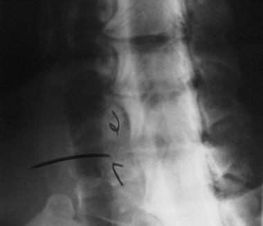 Myelogram of cervical herniated disk. A filling de