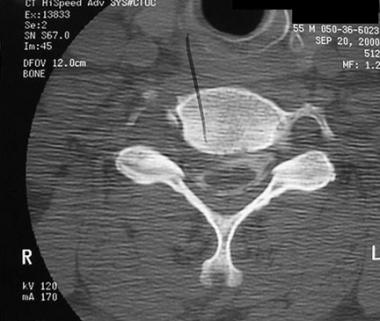 Axial CT scan of cervical herniated nucleus pulpos