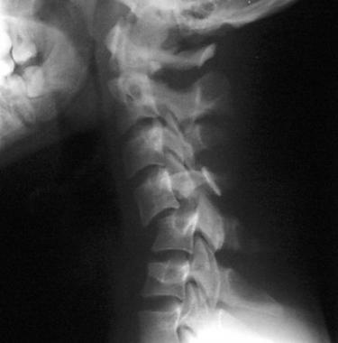 Plain radiograph of jumped facets of C4 on C5. 