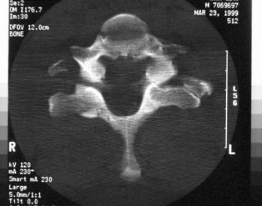 Jumped facets with complete anterior displacement 