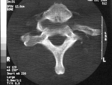 Jumped facet showing anterior displacement of one 