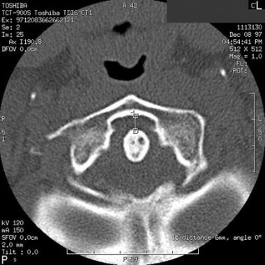 Axial CT scan of an increased atlantodens interval