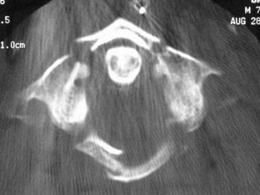 Axial CT scan of a Jefferson fracture. 