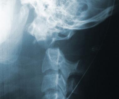 Displaced type II odontoid fracture. 