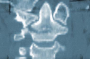 Coronal CT scan of type III odontoid fracture. 