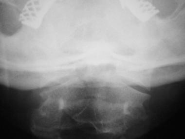 Anteroposterior view of type III odontoid fracture