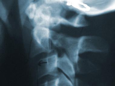 Type I C2 traumatic spondylolisthesis. Note the an