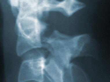 Close-up lateral radiograph of type IIA (Starr-Eis