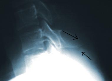 Avulsion fracture of C7 (the clay shoveler's fract