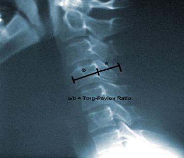 Lateral cervical spine plain radiograph illustrati