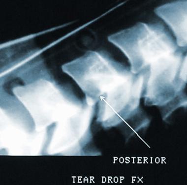 Posterior teardrop fracture. 