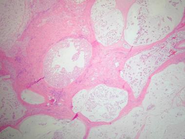 Histologic section demonstrating lobular arrangeme