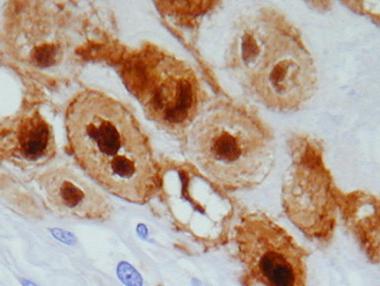 S-100 immunostain of physaliphorous cells demonstr