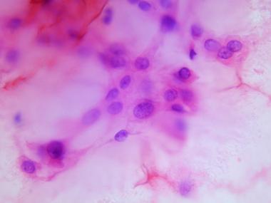 Cytologic preparation demonstrating characteristic