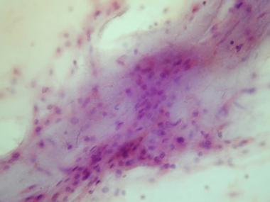 Cytologic preparation demonstrating a sheet of low