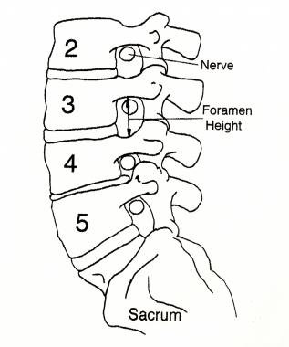 The spinal nerves exit the spinal canal through th