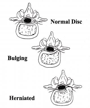 Nuclear material is normally contained within the 