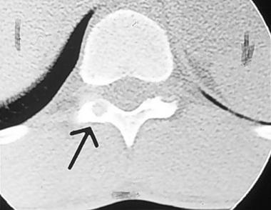 Spinal tumors. Axial CT scan of thoracic vertebra,