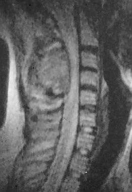 Spinal tumors. MRI of the osteoblastoma in the pos