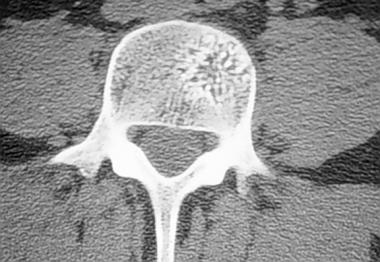 Spinal tumors. Axial CT scan of hemangioma in a lu