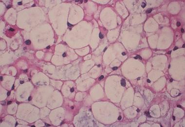 Spinal tumors. Higher magnification of chordoma hi