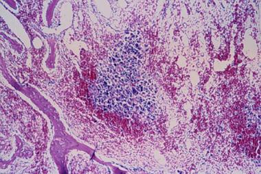 Spinal tumors. Aneurysmal bone cyst histology. 