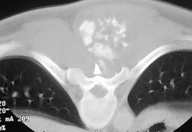 Spinal tumors. Axial CT scan at the level of the c