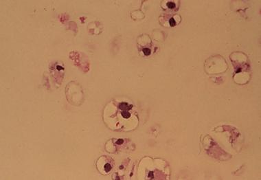 Spinal tumors. Histology of the chondrosarcoma at 