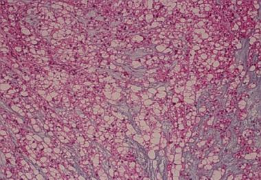 Spinal tumors. Chordoma histology. 