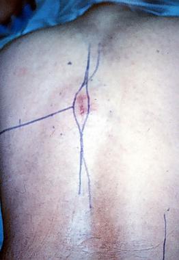 Spinal tumors. Photograph of the patient's back at