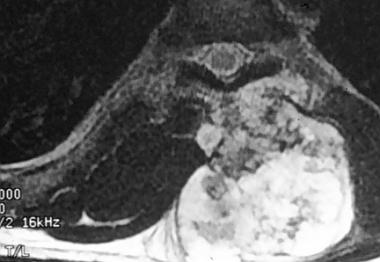 Spinal tumors. T2-weighted MRI scan of the chondro