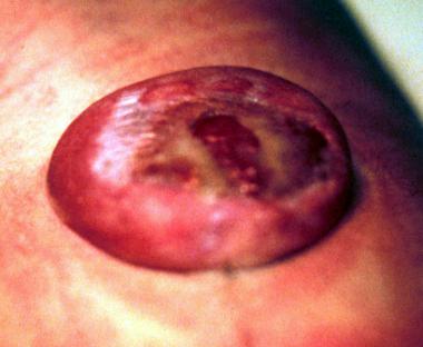 Myelomeningocele in newborn baby. 