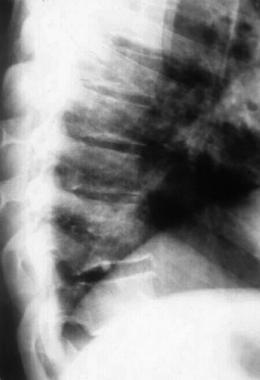 Osteomyelitis of T10. 