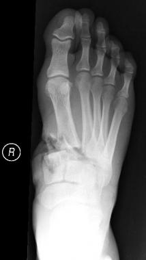 An open midfoot fracture with bone loss at the bas