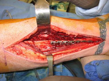 The central aspect of the leg was filled with bone