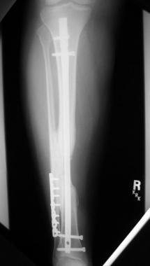 The appearance of the mature synostosis 8 months a