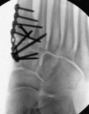 Intraoperative image of the midfoot fusion. The ce