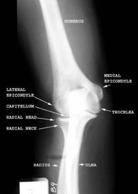 Anteroposterior radiograph of the elbow demonstrat