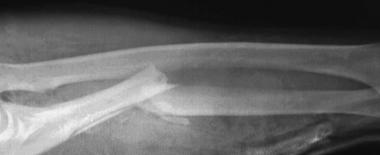 Grade IIIA open ulna fracture in a motorcyclist wi