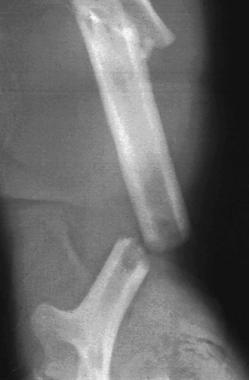 Ipsilateral segmental humeral fracture. 