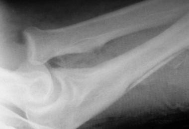 Close-up of radial head dislocation with evidence 