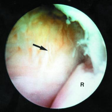 Type I lateral epicondylitis seen through the 30° 