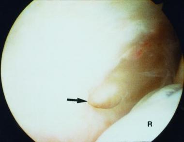 Type 3 lateral epicondylitis showing a large tear 