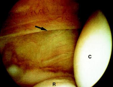 Type 2 lateral epicondylitis showing a linear tear