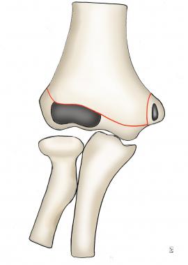 Diagram of intact distal humerus. 