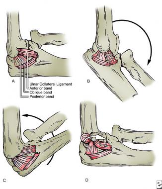 Attachment of medial collateral ligament component